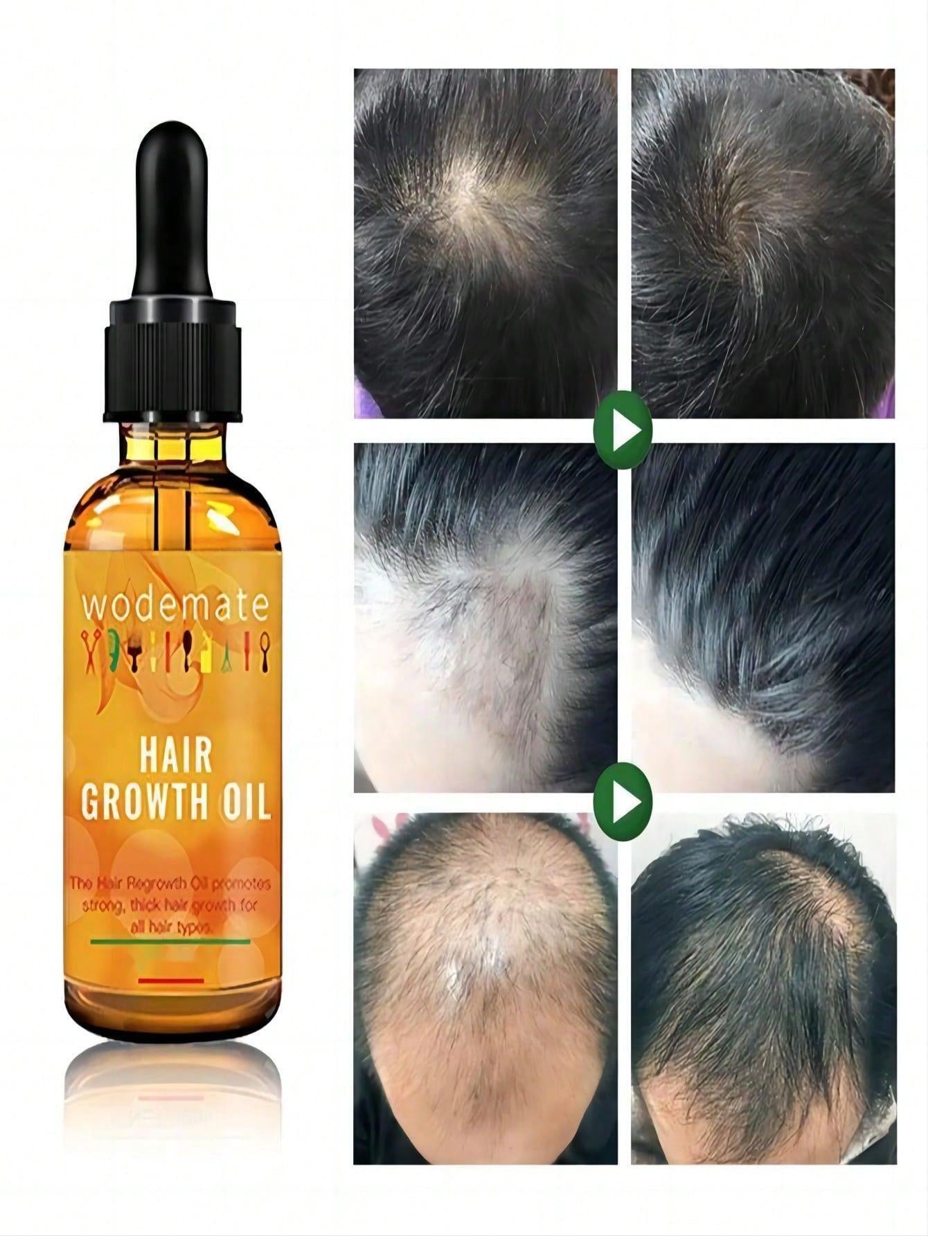 Hair Growth Serum,Ginger Hair Growth Serum Essential Oil Hair Density Serum Hair Growth Oil anti Hair Loss Fast Grow Hair Growth Oil Essential Oil Treatment